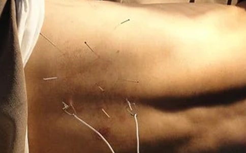 針灸療法 快速燃體內(nèi)脂肪