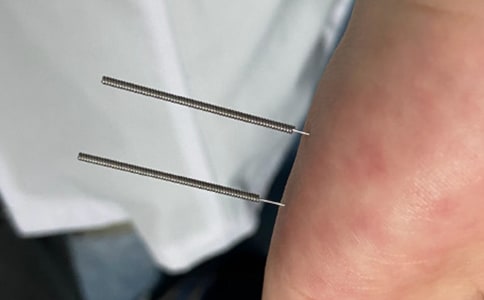 學(xué)習(xí)針灸個(gè)人心得體會(huì)(精選7篇)